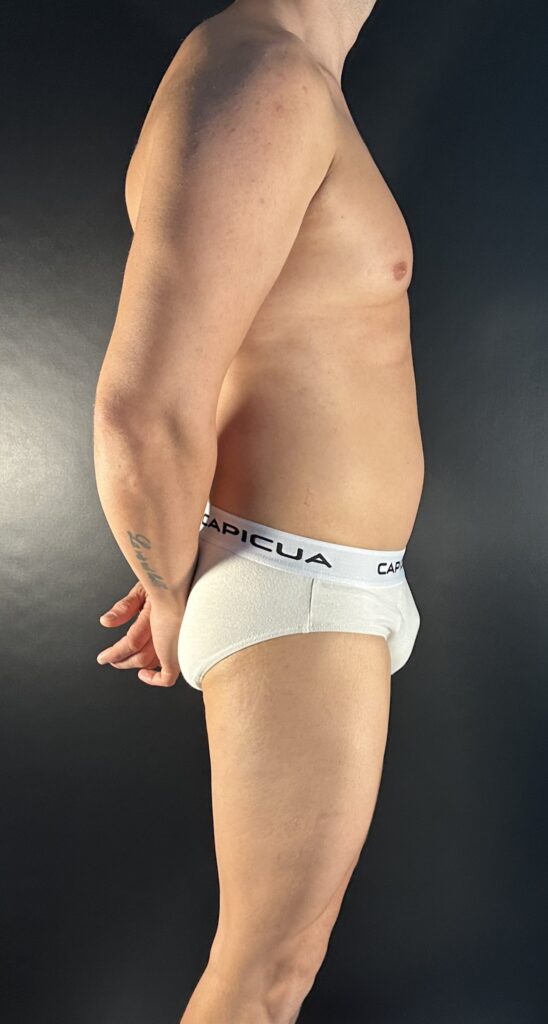 Resultado de lipoescultura hd masculina – antes y después 5
