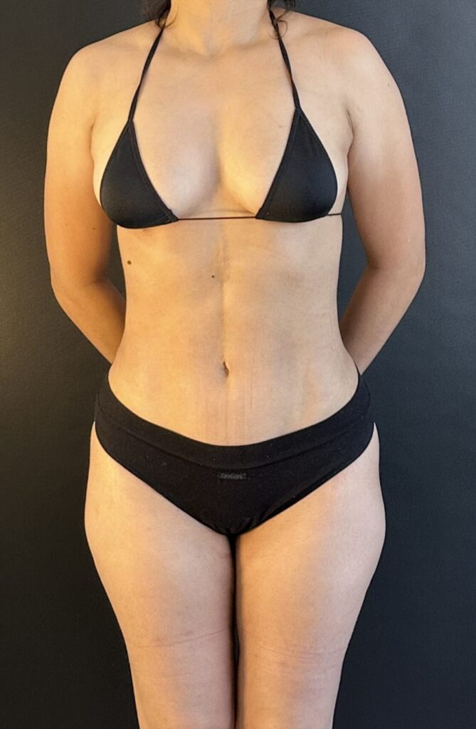 Resultado de lipoescultura hd femenina – antes y después 8