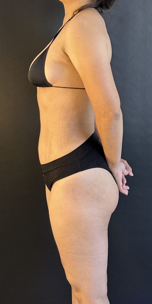 Resultado de lipoescultura hd femenina – antes y después 12