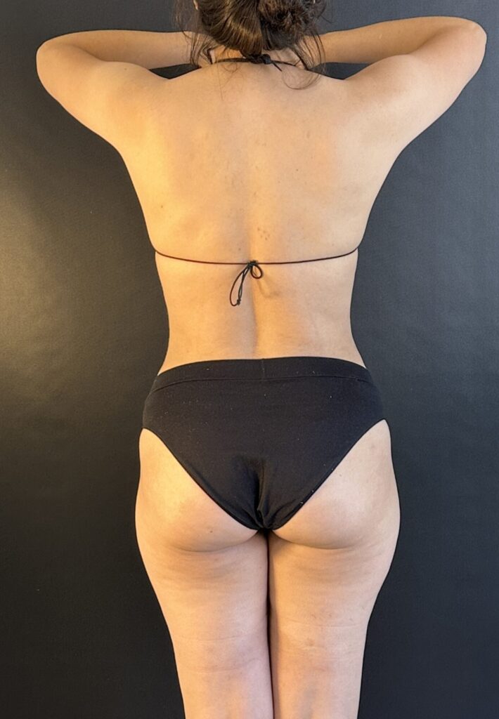 Resultado de lipoescultura hd femenina – antes y después 16