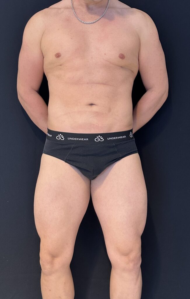 Resultado de lipoescultura hd femenina – antes y después 32