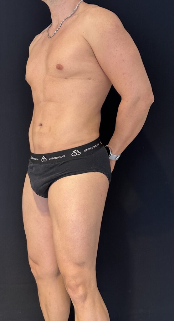 Resultado de lipoescultura hd masculina – antes y después 8
