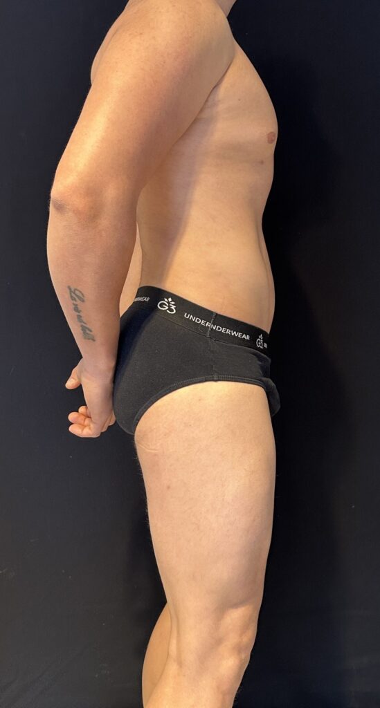 Resultado de lipoescultura hd masculina – antes y después 6
