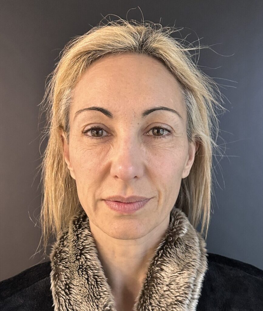 Resultado de lifting facial – antes y después 1