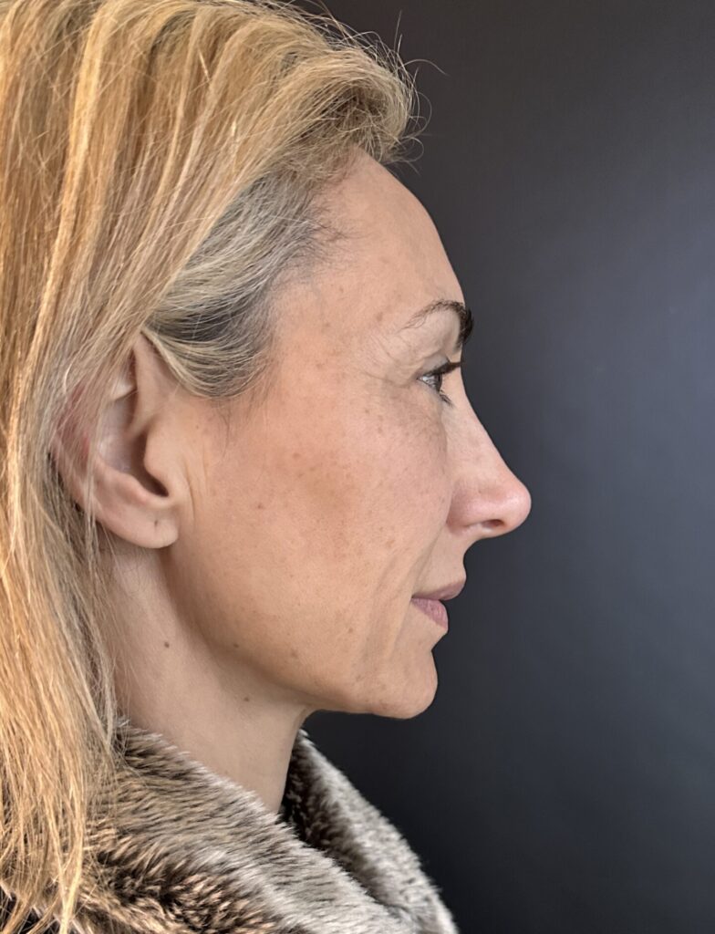 Resultado de lifting facial – antes y después 3
