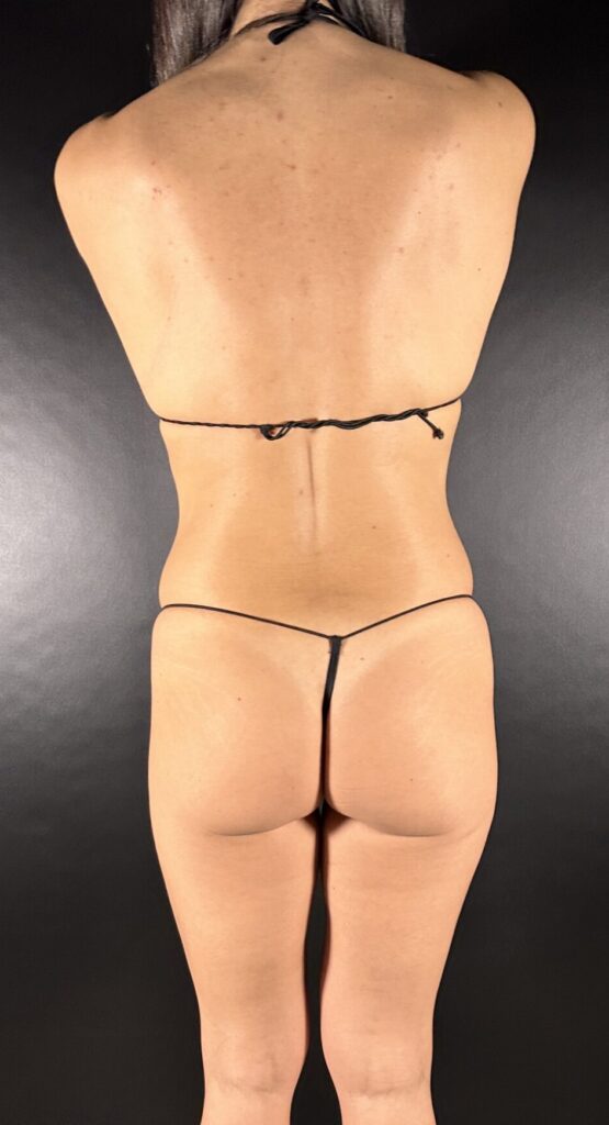 Resultado de lipoescultura hd femenina – antes y después 5