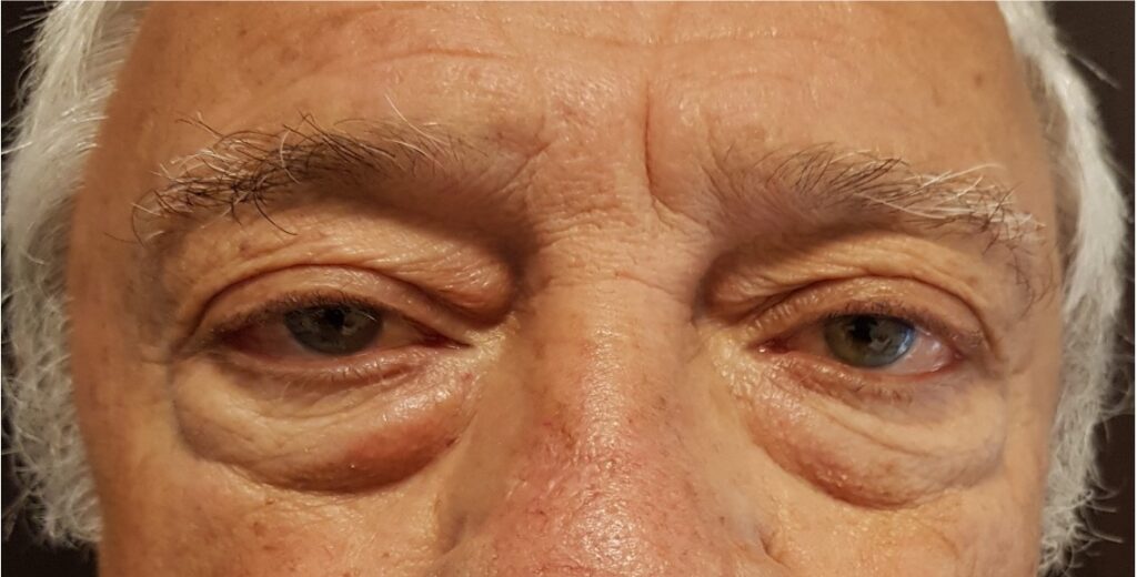 Resultado de blefaroplastia – antes y después 9