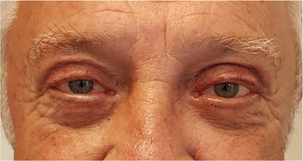 Resultado de blefaroplastia – antes y después 10
