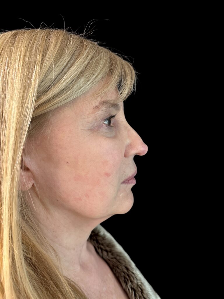 Resultado de rinoplastia ultrasónica estructurada – antes y después 7