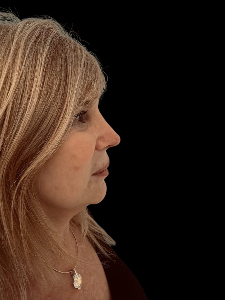 Resultado de rinoplastia ultrasónica estructurada – antes y después 8