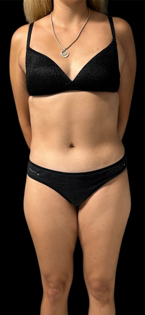 Resultado de abdominoplastia + lipoescultura hd – antes y después 22