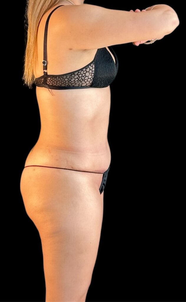 Resultado de abdominoplastia + lipoescultura hd – antes y después 26