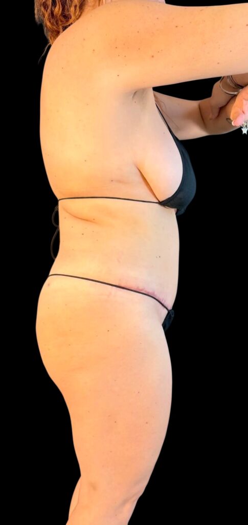 Resultado de abdominoplastia + lipoescultura hd – antes y después 20