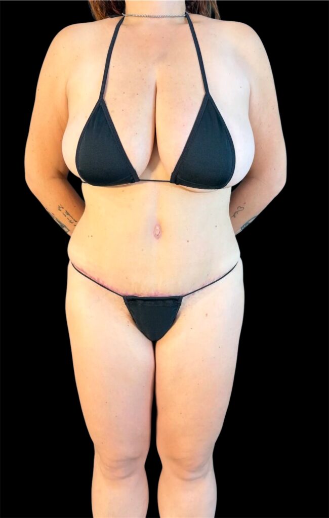 Resultado de abdominoplastia + lipoescultura hd – antes y después 16
