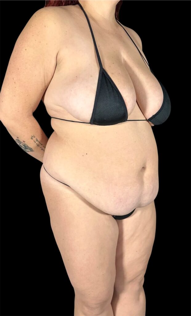 Resultado de abdominoplastia + lipoescultura hd – antes y después 17