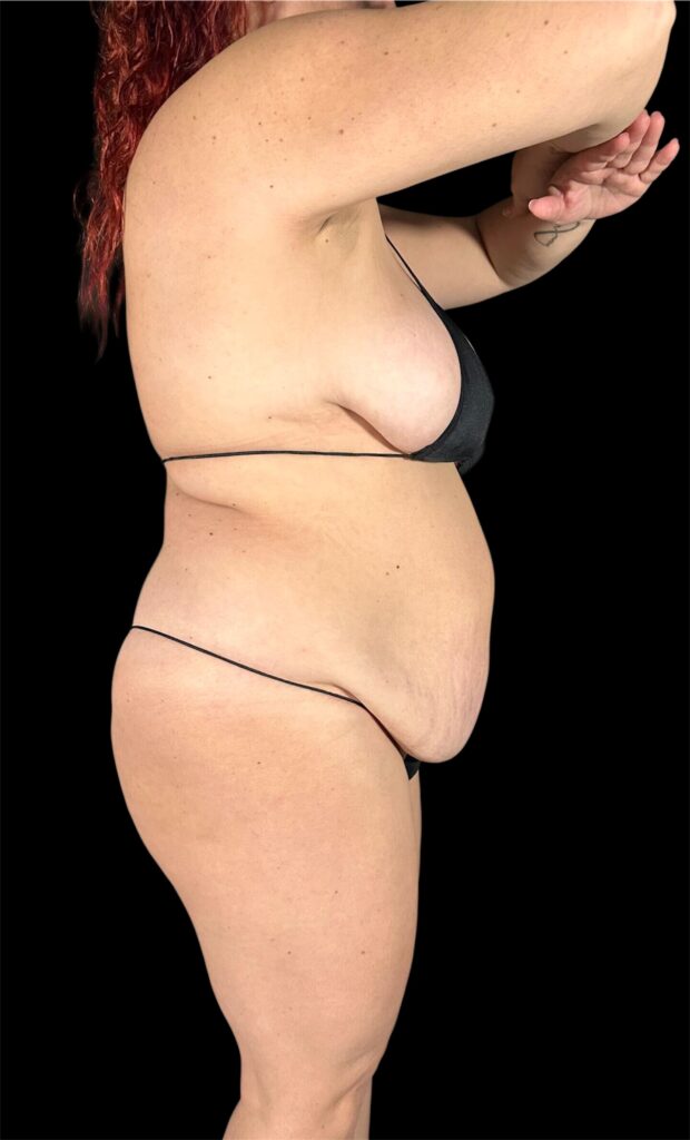 Resultado de abdominoplastia + lipoescultura hd – antes y después 19
