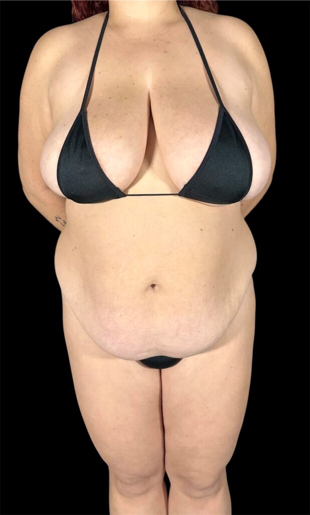 Resultado de abdominoplastia + lipoescultura hd – antes y después 15