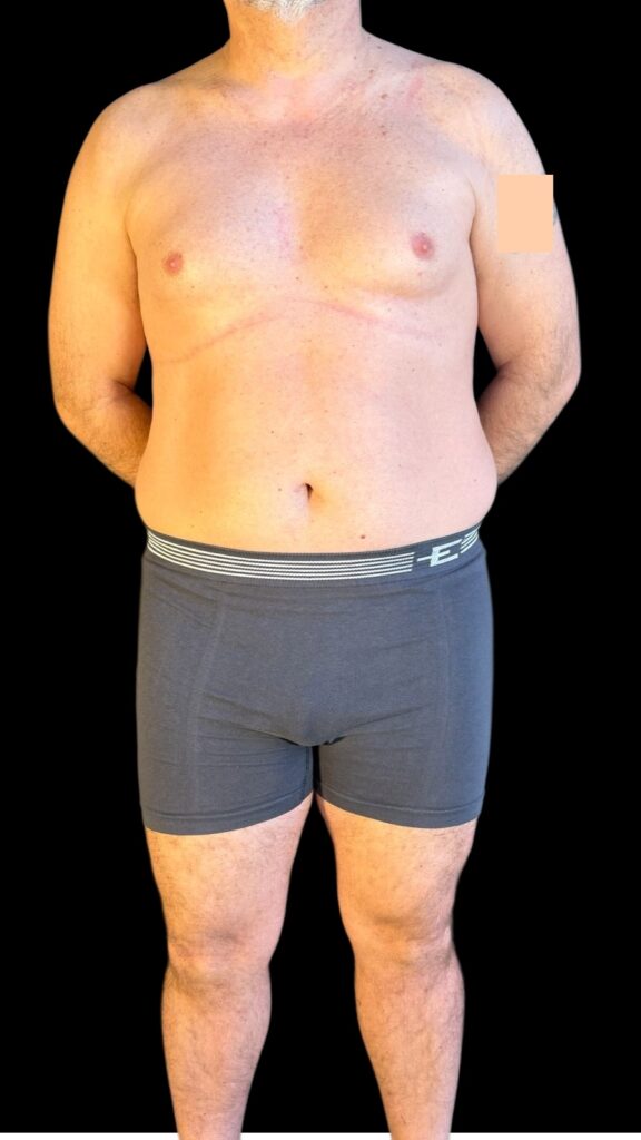Resultado de lipoescultura hd femenina – antes y después 49