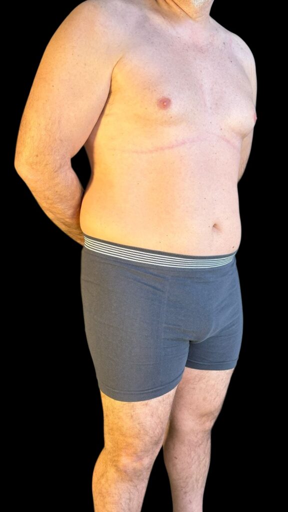 Resultado de lipoescultura hd femenina – antes y después 51