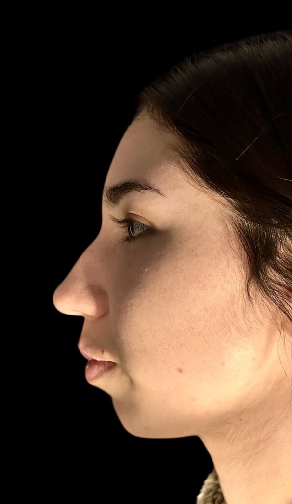 Resultado de rinoplastia ultrasónica estructurada – antes y después 1