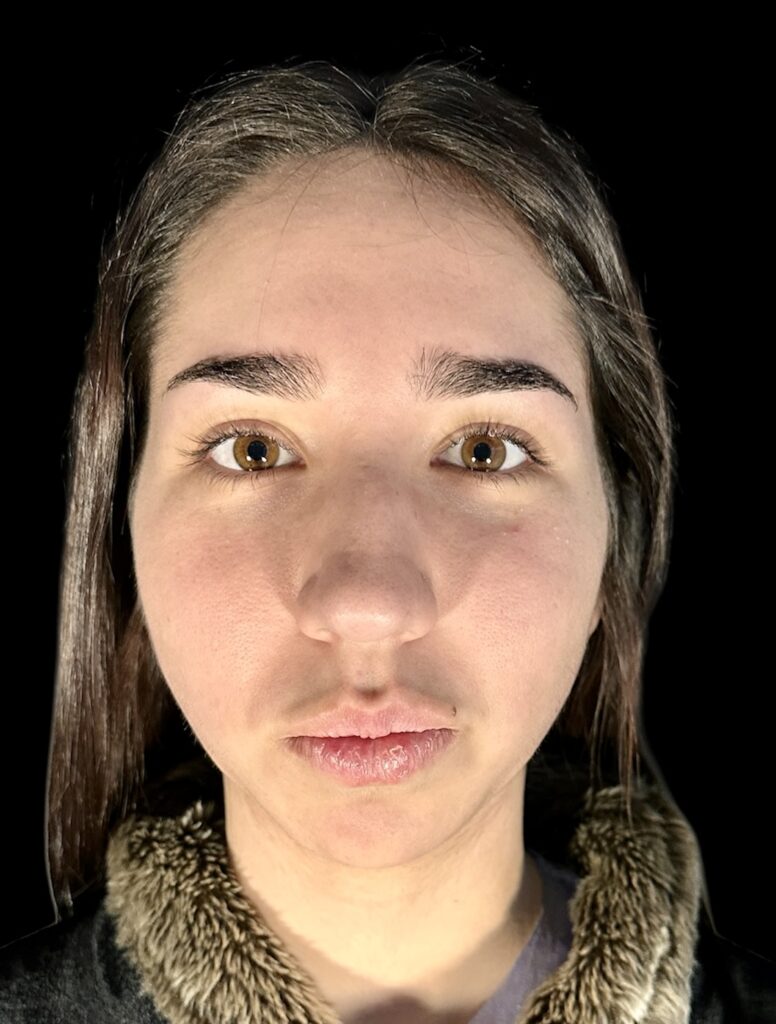 Resultado de rinoplastia ultrasónica estructurada – antes y después 5