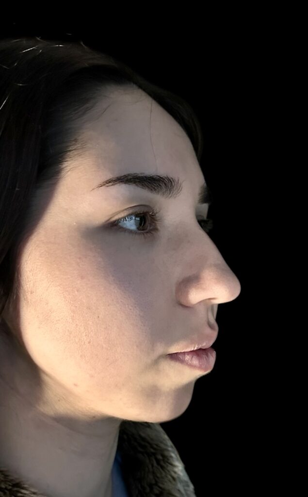 Resultado de rinoplastia ultrasónica estructurada – antes y después 3