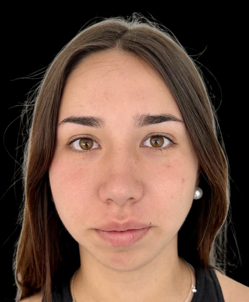 Resultado de rinoplastia ultrasónica estructurada – antes y después 6