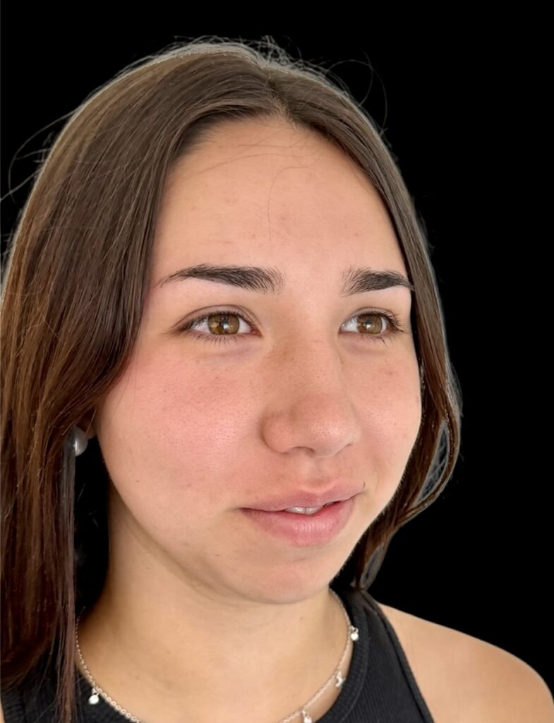 Resultado de rinoplastia ultrasónica estructurada – antes y después 4