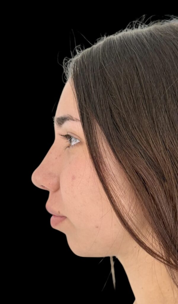 Resultado de rinoplastia ultrasónica estructurada – antes y después 2