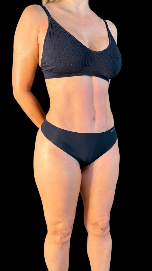Resultado de lipoescultura hd femenina – antes y después 20