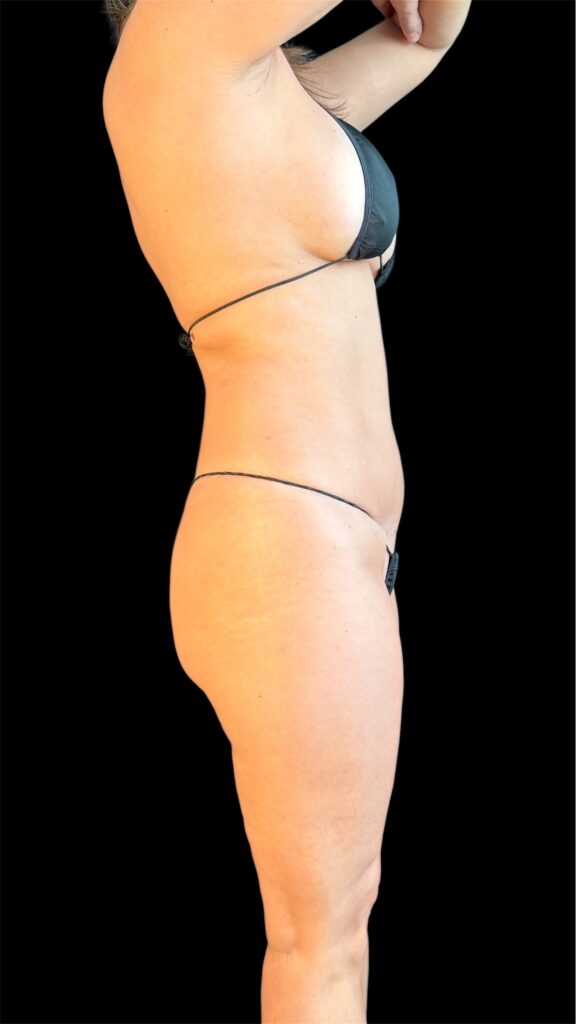 Resultado de lipoescultura hd femenina – antes y después 21