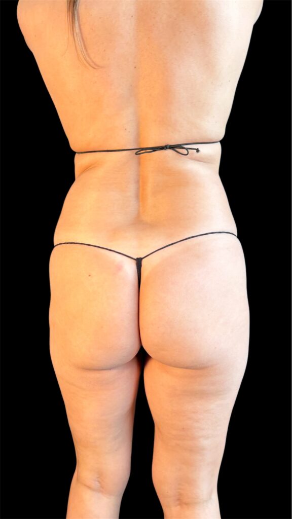 Resultado de lipoescultura hd femenina – antes y después 23