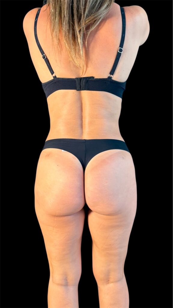 Resultado de lipoescultura hd femenina – antes y después 24