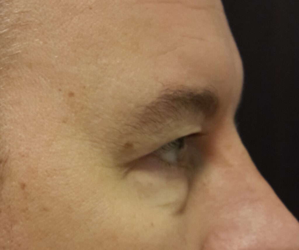 Resultado de blefaroplastia – antes y después 7