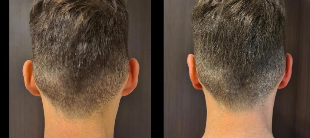 Resultado de otoplastia – antes y después 1