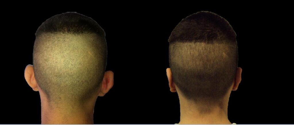 Resultado de otoplastia – antes y después 2