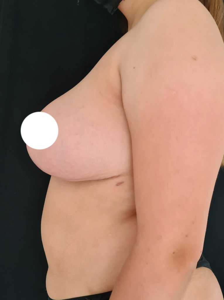 Resultado de reducción mamaria – antes y después 12