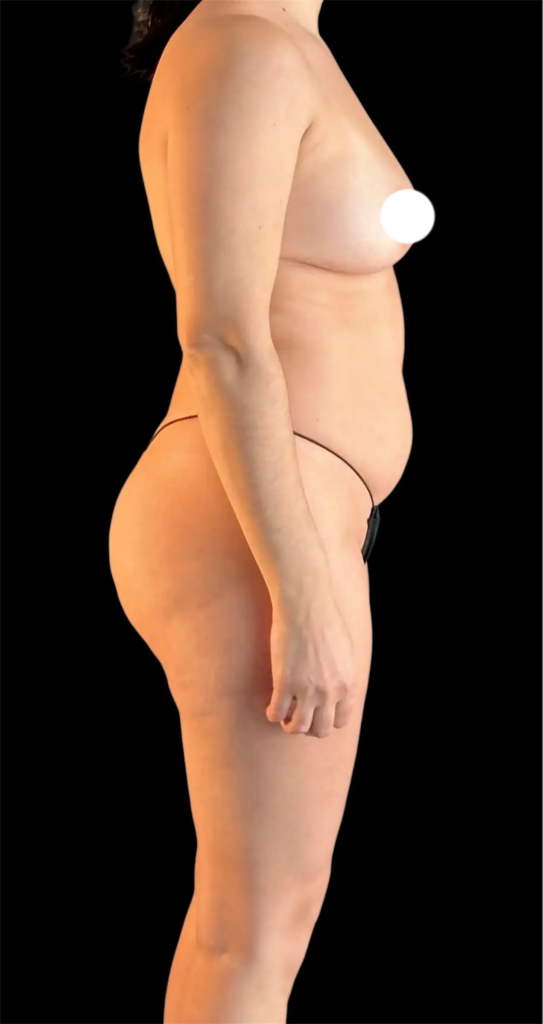 Resultado de abdominoplastia + lipoescultura hd – antes y después 9
