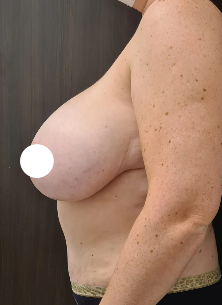 Resultado de reducción mamaria – antes y después 15