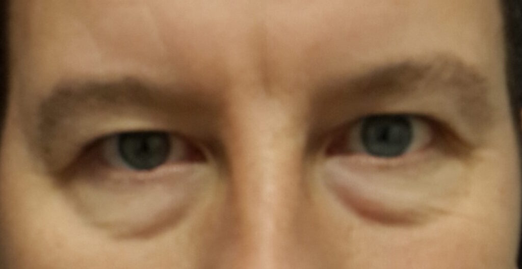 Resultado de blefaroplastia – antes y después 5
