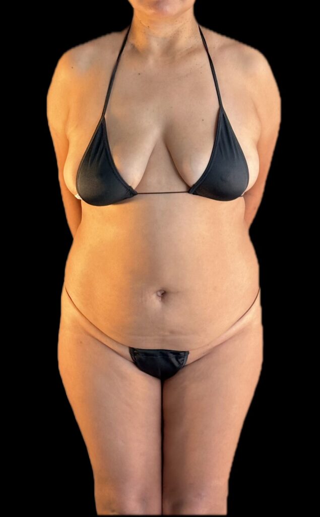 Resultado de abdominoplastia + lipoescultura hd – antes y después 1