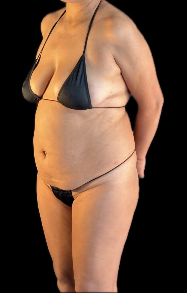 Resultado de abdominoplastia + lipoescultura hd – antes y después 5