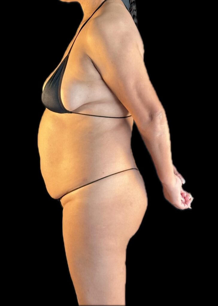 Resultado de abdominoplastia + lipoescultura hd – antes y después 3