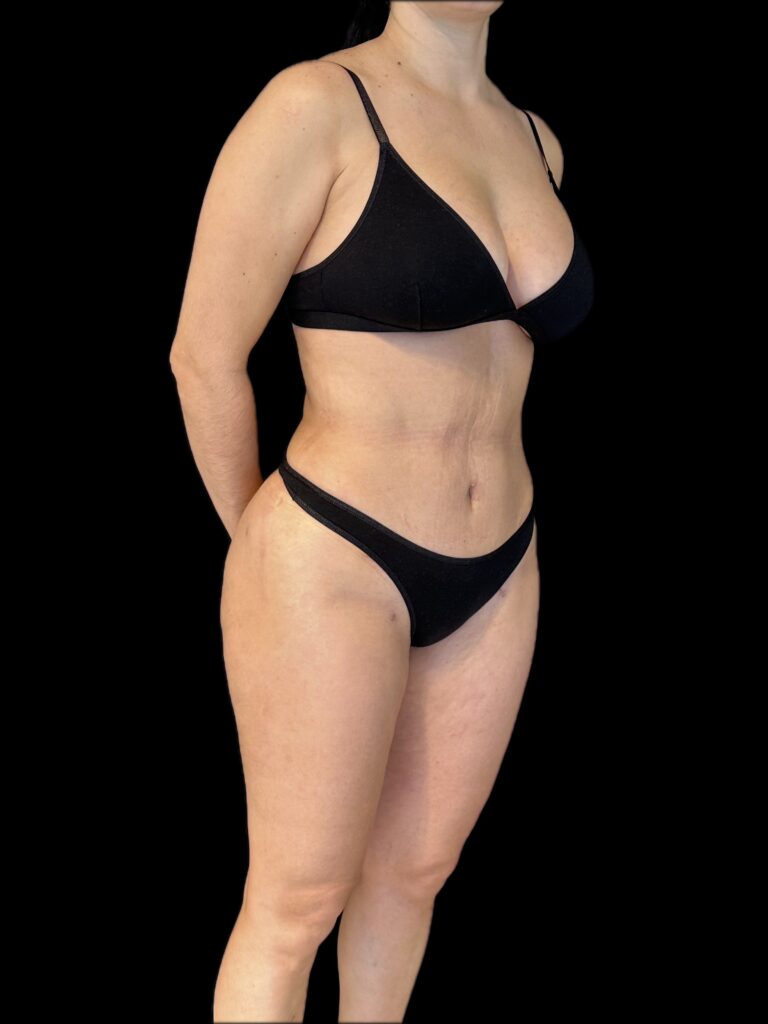 Resultado de abdominoplastia + lipoescultura hd – antes y después 12