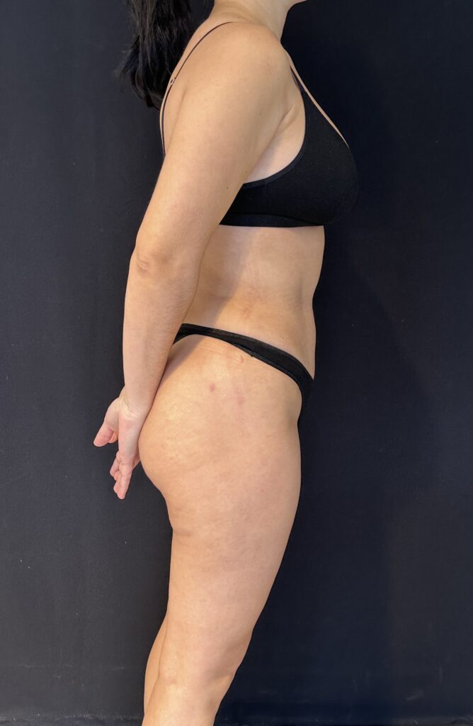 Resultado de abdominoplastia + lipoescultura hd – antes y después 10