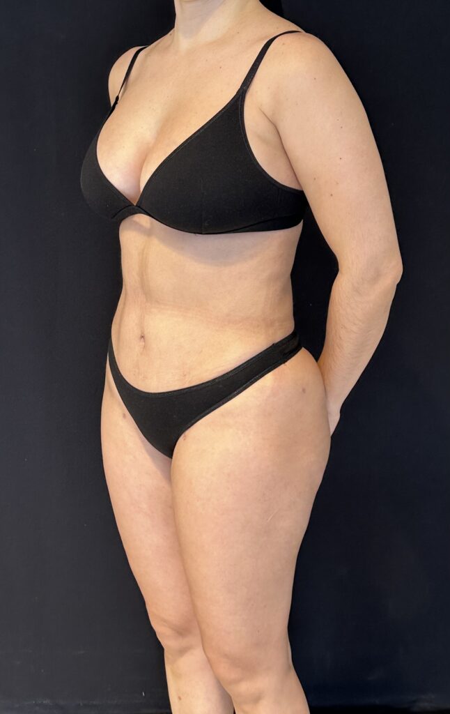 Resultado de abdominoplastia + lipoescultura hd – antes y después 14