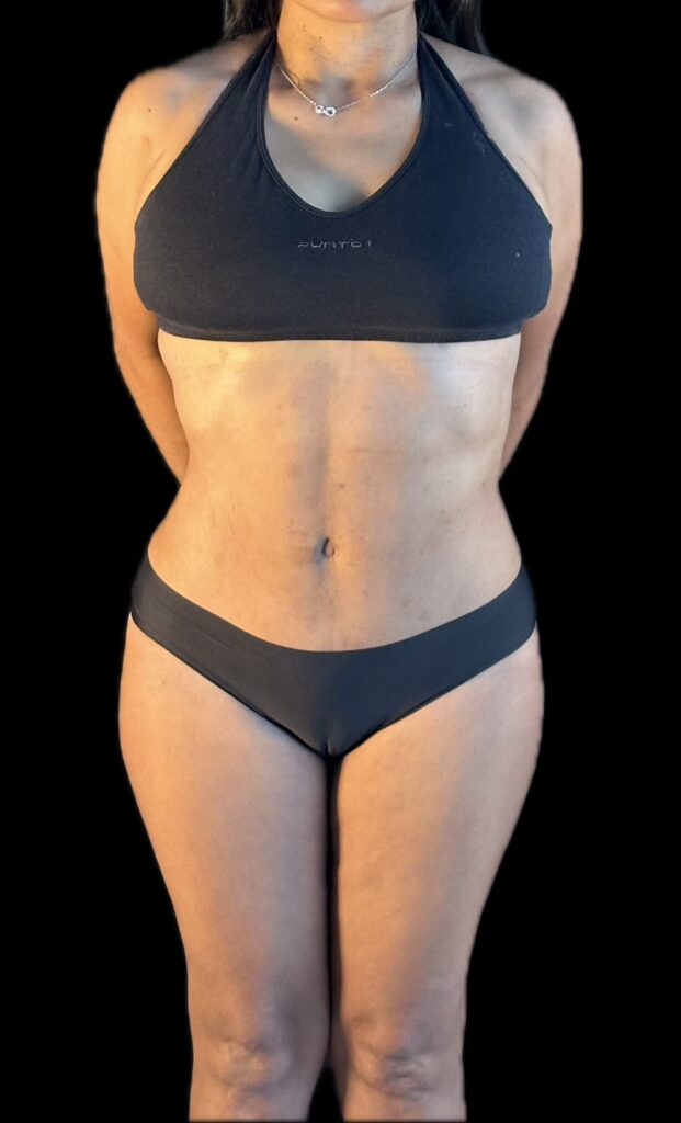 Resultado de abdominoplastia + lipoescultura hd – antes y después 2