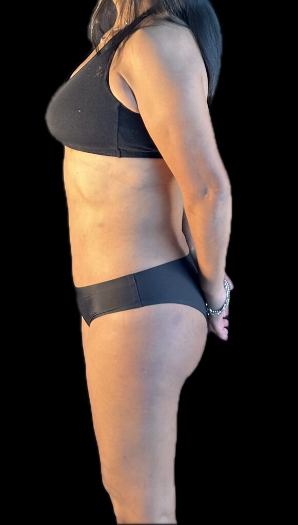 Resultado de abdominoplastia + lipoescultura hd – antes y después 4