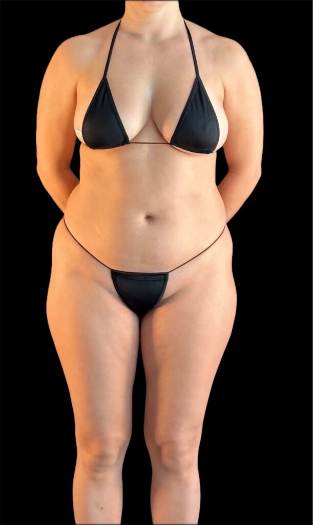 Resultado de abdominoplastia + lipoescultura hd – antes y después 7