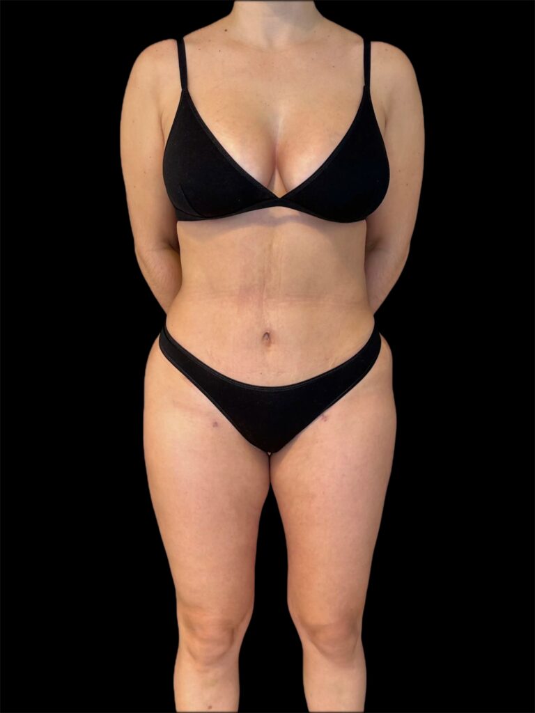 Resultado de abdominoplastia + lipoescultura hd – antes y después 8